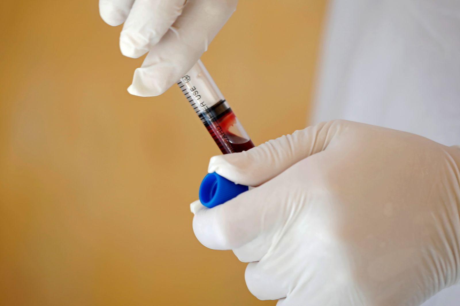 Simple Blood Test For Alzheimer’s Becoming Closer To Reality | The ...